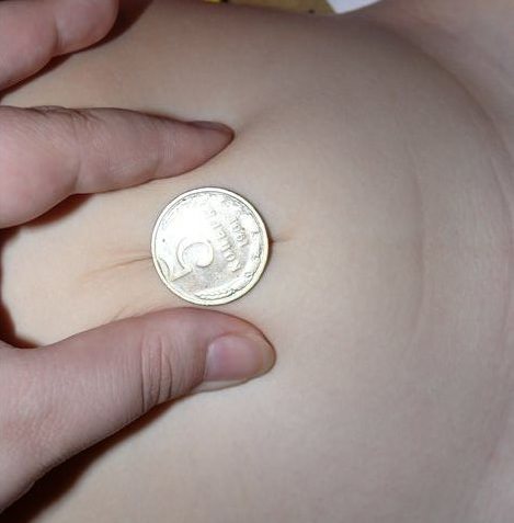 монетка на пупочной грыже ребенка