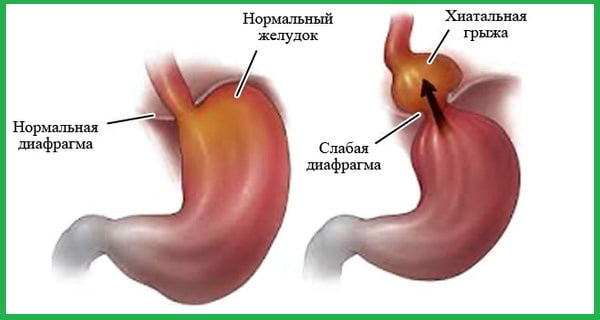 Слева нормальный желудок и нормальная диафрагма, справа - слабая диафрагма и хиатальная грыжа.