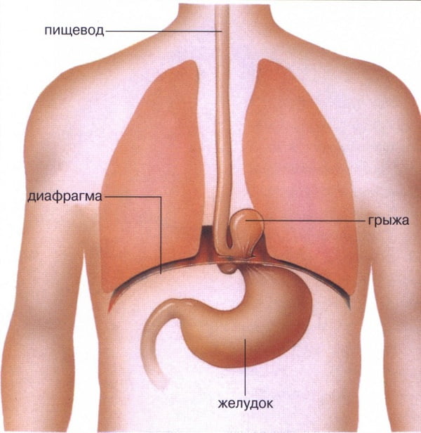 Схематичный рисунок грыжи желудка