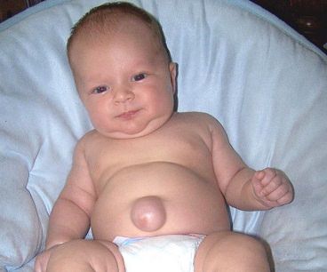 На фото новорожденный с пупочной грыжей