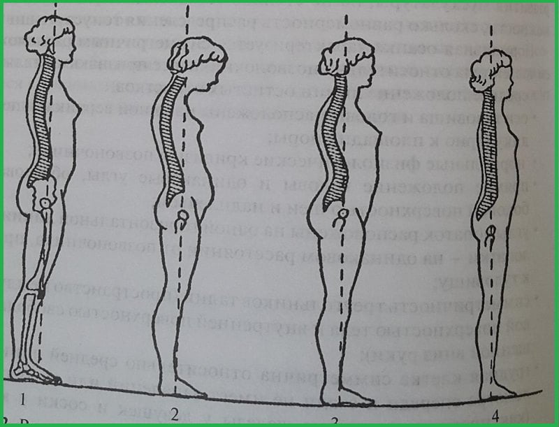 Рисунок о развитие сколиоза у женщин.
